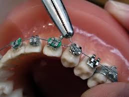 Braces being adjusted